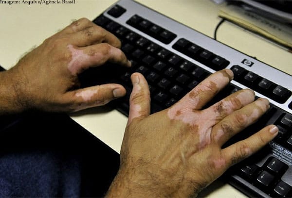 Imagem da notcia Fatores emocionais podem desencadear ocorrncia do vitiligo