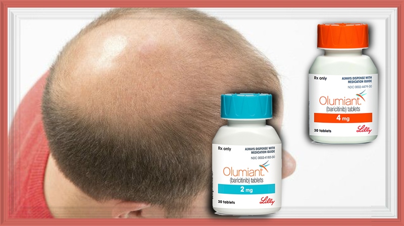 Alopecia: FDA aprova Olumiant para tratamento de queda de cabelo