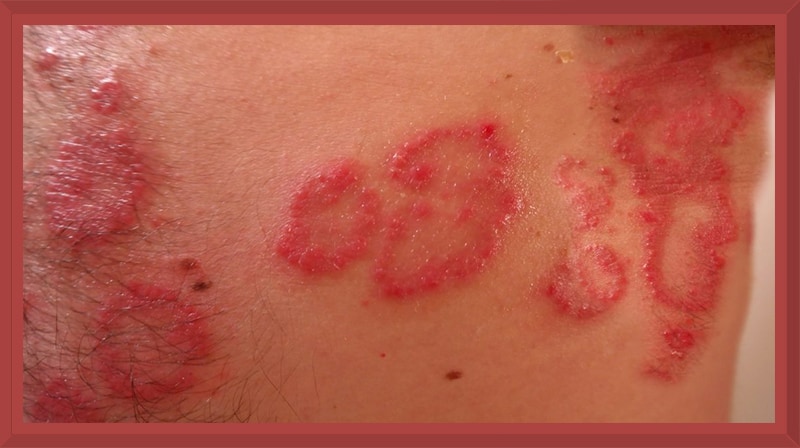 Dermatite atópica: Tratamento com extrato de ácaros?
