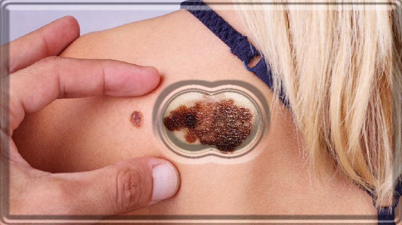 O primeiro passo para impedir a propagação do melanoma