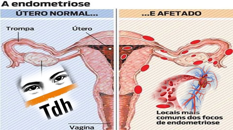 Por que Médicos subdiagnosticam em mulheres? Endometriose, Doença Cardíaca Coronariana e TDH