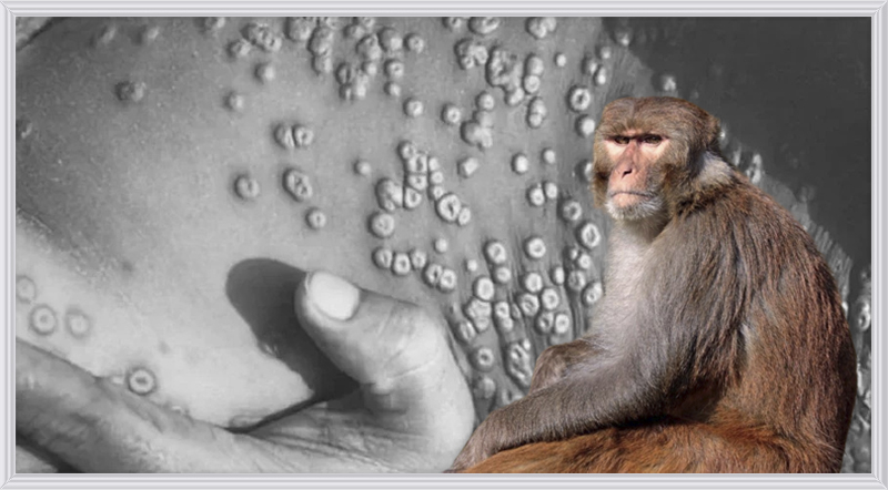 Surto de varíola: o que saber