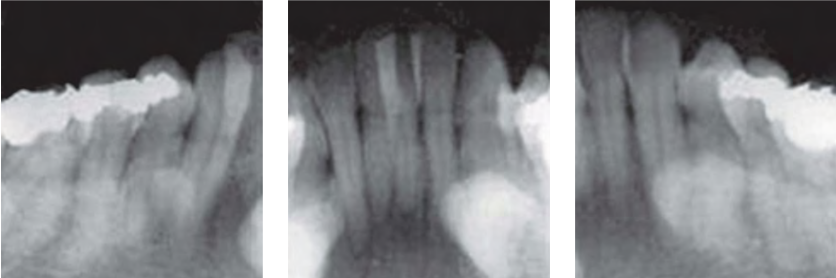 periapical%20inf%20inicial.png